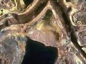 What Honeycombing Lungs Best Alternative Treatment?