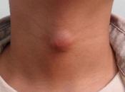 Ayurvedic Treatment Thyroglossal Duct Cyst