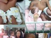 Nigerian Hospital Announces First Successful Separation Conjoined Twins After Months Surgery