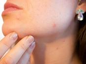 Acne Scars Forever: Must-Try Scar Treatments