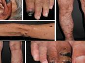 Treatment Urticarial Vasculitis Through Ayurveda