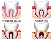 Ayurvedic Treatment Help Periodontal Disease?