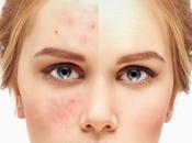 Keto Low-carb Diets Improve Acne?