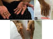 Alternative Ayurvedic Treatment CIDP