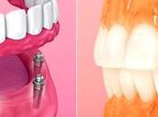 What Right Between Dental Implants Dentures?