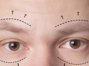 What Should Know About Blepharoplasty Singapore
