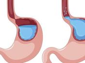 What Natural Remedies GERD?(Gastroesophageal Reflux Disease)