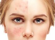 Acne with Help CAC?