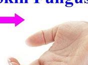 Treat Fungal Infection Through Ayurveda?