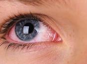 Treat Conjunctivitis Ayurveda?