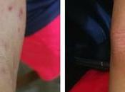 Keto Diet Help Treat Eczema?