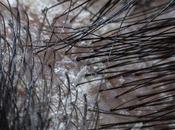 Scalp Infection Severe Dandruff Naturally