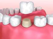 Things Need Know About Dental Crowns Bridges