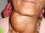 Goiter Herbal Natural Treatment