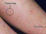 Reduction Platelet Count Becoming Common Problem. Does Ayurveda Help Increasing Count?