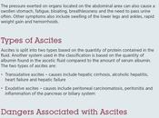 Ascites: Symptoms, Causes Treatment