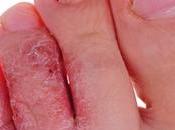 Home Remedies Athletes Foot