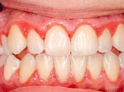 Home Remedies Gingivitis