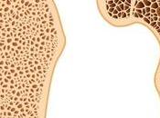 What Treatment Osteoporosis?