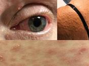 Treatment Syphilis Ayurveda with Herbal Remedies