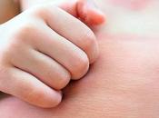 Prevention Treatment Atopic Dermatitis (Eczema)