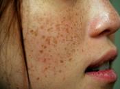 Remove Dark Spots Face Overnight Home Remedies