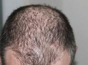 Alopecia