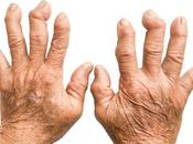 Amavata (rhumatoid Artheritis)