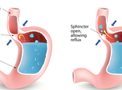 Gastroesophageal Reflux Disease GERD (Amlapitta)