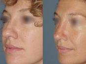BEFORE/AFTER: Natural Rhinoplasty