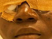 “HelpMeSee” Face Cataract Blindness