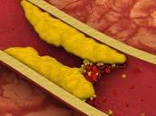 Remedies Blocked Arteries