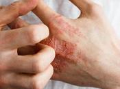 Eczema (Vicharchika)