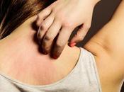 Urticaria (Sheetpitta)