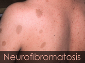 Ayurvedic Treatment Neurofibromatosis