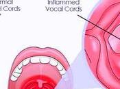 Herbal Remedies Chronic Laryngitis, Ayurvedic Treatment Causes Symptoms