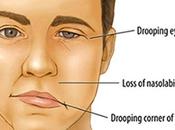 Facial Paralysis (Ardita)