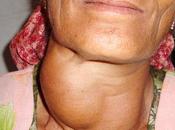 Ayurvedic Treatment Goitre