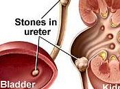 Prevent Kidney Stones