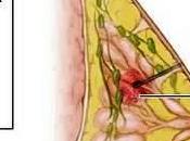 Core-needle Biopsy Result Under-staging Breast Cancer