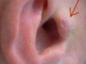 Freaky Gets Invisible Headphones Implanted Ears