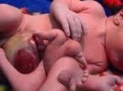 Toxic Weapons Blamed Iraq's Birth Defects (Video)