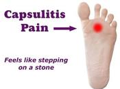 Have Pain Ball Your Foot? Diagnose Treat Capsulitis