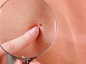 Cancerous Skin Tags Should Worry About Growth