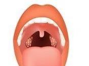 Ayurvedic Treatment Tonsilitis