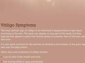 Vitiligo: Symptoms, Causes Treatment