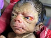 Bangladesh: Bébé Avec L’apparence D’un Vieil Homme (Vidéo)