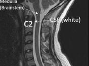 Have Cervical Medullary Syndrome?