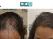 Hair Transplant Chennai India