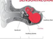 Herbal Remedy Sensorineural Hearing Loss